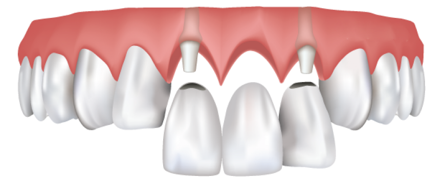Абатмент в стоматологии